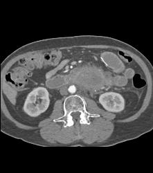 Small Bowel Adenocarcinoma - CTisus CT Scan