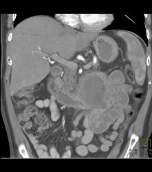 Small Bowel Adenocarcinoma - CTisus CT Scan