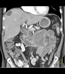 Small Bowel Adenocarcinoma - CTisus CT Scan