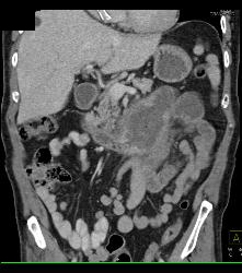 Small Bowel Adenocarcinoma - CTisus CT Scan