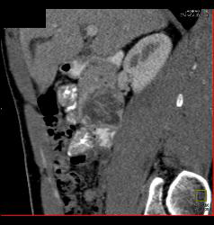 GIST Tumor Duodenum- Atypical - CTisus CT Scan