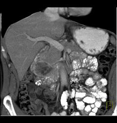 GIST Tumor Duodenum- Atypical - CTisus CT Scan