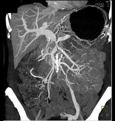 Pancreatic Cancer Encases the PV/SMV/SV With Collaterals and Sclerosing Mesenteritis - CTisus CT Scan