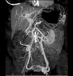 Pancreatic Cancer Encases the PV/SMV/SV With Collaterals and Sclerosing Mesenteritis - CTisus CT Scan