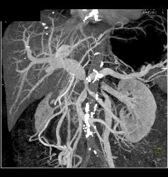 Pancreatic Cancer Encases the PV/SMV/SV With Collaterals and Sclerosing Mesenteritis - CTisus CT Scan