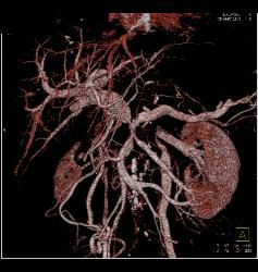 Pancreatic Cancer Encases the PV/SMV/SV With Collaterals and Sclerosing Mesenteritis - CTisus CT Scan