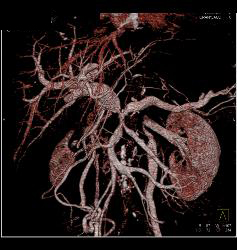 Pancreatic Cancer Encases the PV/SMV/SV With Collaterals and Sclerosing Mesenteritis - CTisus CT Scan