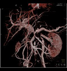 Pancreatic Cancer Encases the PV/SMV/SV With Collaterals and Sclerosing Mesenteritis - CTisus CT Scan