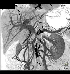 Pancreatic Cancer Encases the PV/SMV/SV With Collaterals and Sclerosing Mesenteritis - CTisus CT Scan