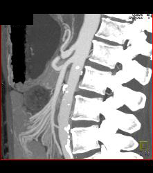 Superior Mesenteric Artery (SMA) Syndrome - CTisus CT Scan