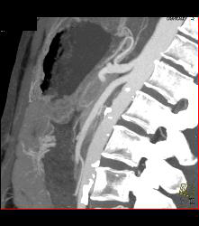 Superior Mesenteric Artery (SMA) Syndrome - CTisus CT Scan