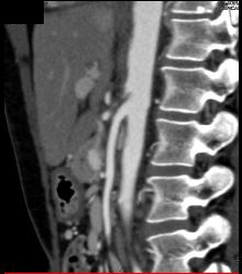 Superior Mesenteric Artery (SMA) Syndrome - CTisus CT Scan