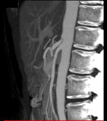 Superior Mesenteric Artery (SMA) Syndrome - CTisus CT Scan