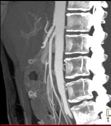 Superior Mesenteric Artery (SMA) Syndrome - CTisus CT Scan