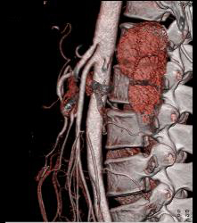 Superior Mesenteric Artery (SMA) Syndrome - CTisus CT Scan