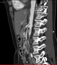 Superior Mesenteric Artery (SMA) Syndrome - CTisus CT Scan