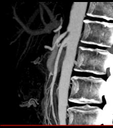 Superior Mesenteric Artery (SMA) Syndrome - CTisus CT Scan