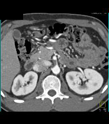 Plaque in Proximal SMA - CTisus CT Scan