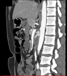 Median Arcuate Ligament Syndrome Collaterals - CTisus CT Scan