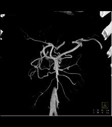 Median Arcuate Ligament Syndrome Collaterals - CTisus CT Scan