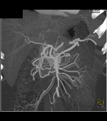 Median Arcuate Ligament Syndrome Collaterals - CTisus CT Scan