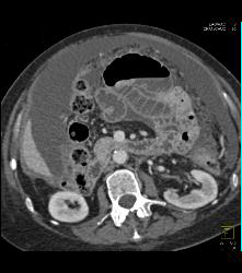 Pseudomyxoma Peritonei (PMP) - CTisus CT Scan