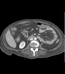 Poor Flow in Mesenteric Vessels With Thick Small Bowel Loops - CTisus CT Scan