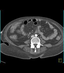 Poor Flow in Mesenteric Vessels With Thick Small Bowel Loops - CTisus CT Scan