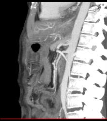 Poor Flow in Mesenteric Vessels With Thick Small Bowel Loops - CTisus CT Scan