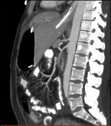 Poor Flow in Mesenteric Vessels With Thick Small Bowel Loops - CTisus CT Scan