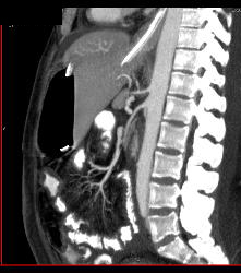 Poor Flow in Mesenteric Vessels With Thick Small Bowel Loops - CTisus CT Scan