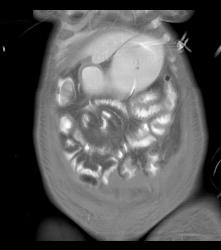 Thickened Small Bowel Loops With Mesenteric Inflammation - CTisus CT Scan