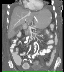 Thickened Small Bowel Loops With Mesenteric Inflammation - CTisus CT Scan