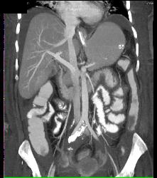 Thickened Small Bowel Loops With Mesenteric Inflammation - CTisus CT Scan