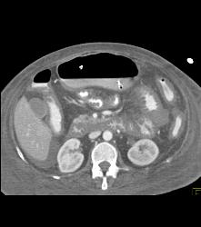 Thickened Small Bowel Loops With Mesenteric Inflammation - CTisus CT Scan