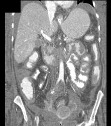 Wet Bowel Pattern and Low Flow State With Small Mesenteric Vessels- Celiac, SMA - CTisus CT Scan