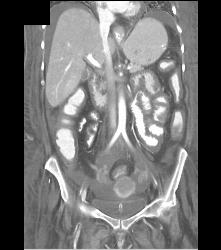 Wet Bowel Pattern and Low Flow State With Small Mesenteric Vessels- Celiac, SMA - CTisus CT Scan