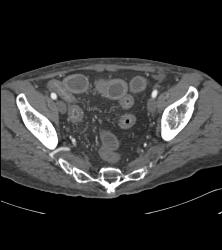 Crohn's Disease - CTisus CT Scan