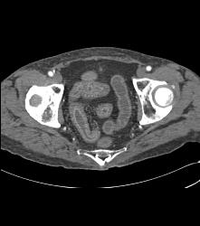 Crohn's Disease - CTisus CT Scan