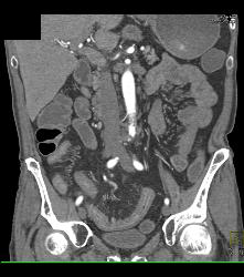 Crohn's Disease - CTisus CT Scan