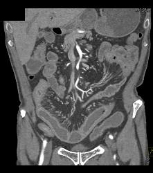 Crohn's Disease - CTisus CT Scan