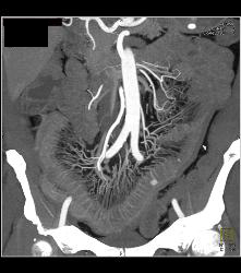 Prominent Vasa Recta Due to Crohn's Disease - CTisus CT Scan