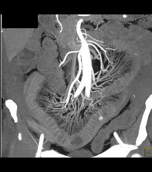 Prominent Vasa Recta Due to Crohn's Disease - CTisus CT Scan