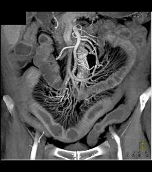 Prominent Vasa Recta Due to Crohn's Disease - CTisus CT Scan