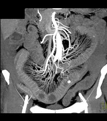 Prominent Vasa Recta Due to Crohn's Disease - CTisus CT Scan