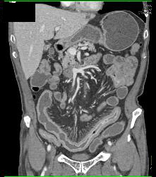 Prominent Vasa Recta Due to Crohn's Disease - CTisus CT Scan