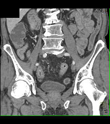 Prominent Vasa Recta Due to Crohn's Disease - CTisus CT Scan