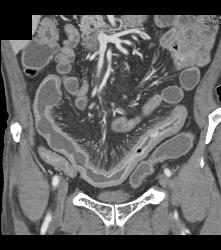 Prominent Vasa Recta Due to Crohn's Disease - CTisus CT Scan