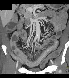 Prominent Vasa Recta Due to Crohn's Disease - CTisus CT Scan