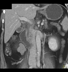 Thickened Duodenum With Mild Inflammatory Disease - CTisus CT Scan